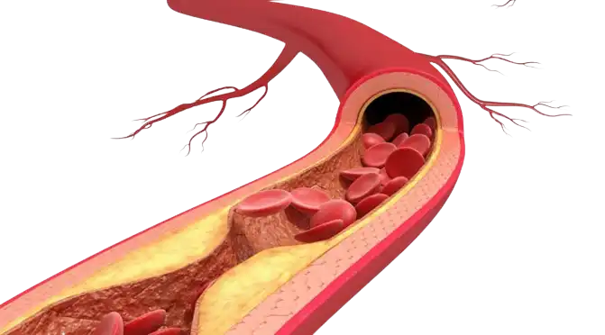 Lose Bad Cholesterol: The Untold Method Revealed